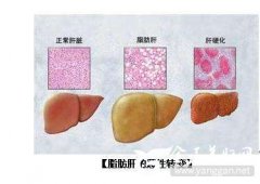 脂肪肝导致肝脏病变的介绍